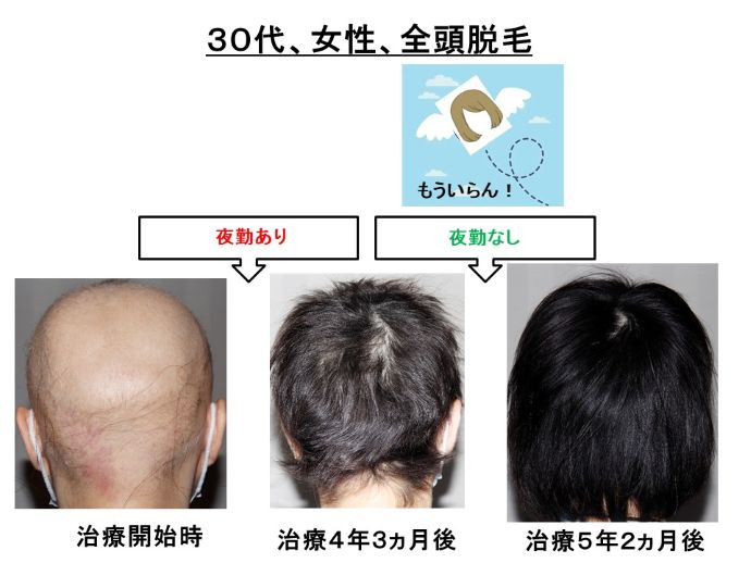 円形脱毛症　病院